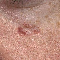 Example of skinCancer